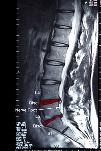 Chiropractic Covington GA Spine X-Ray